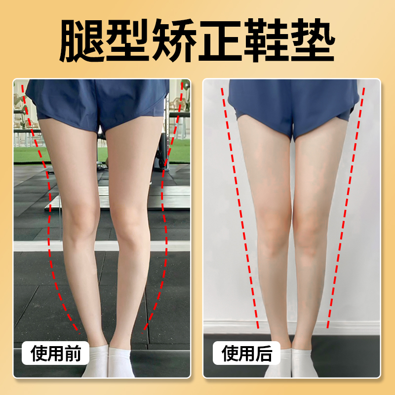 O型腿矫正鞋垫美腿神器腿型纠正矫正直腿小腿外翻内外八字x矫正器 - 封面
