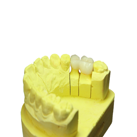 【上海吴勇芬口腔诊所】3m 纳米光固化树脂补牙,超硬树脂补牙