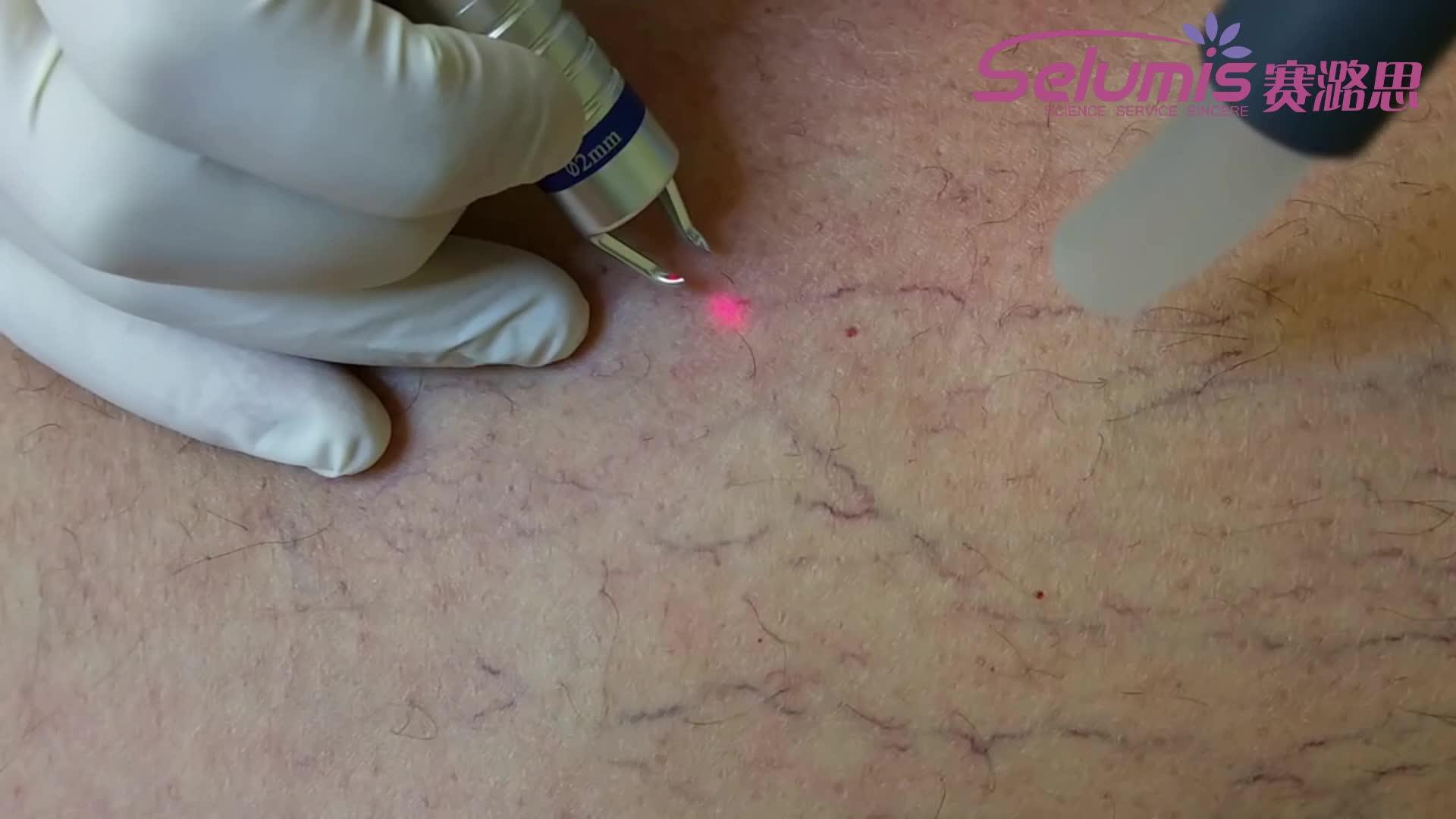 良好的工厂血管去除激光 940nm 激光二极管蜘蛛静脉腿部静脉治疗