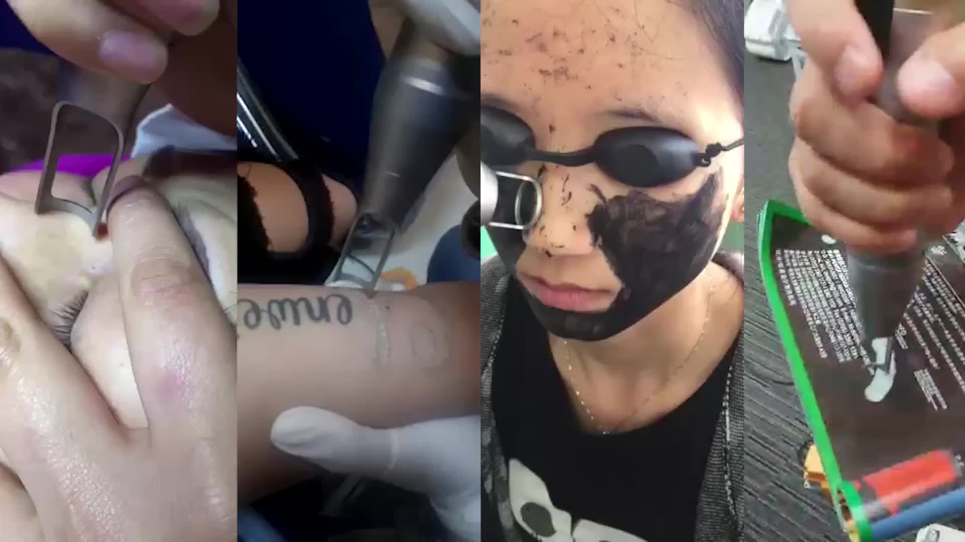 Лазер для выведения тату Лазер для выведения тату
