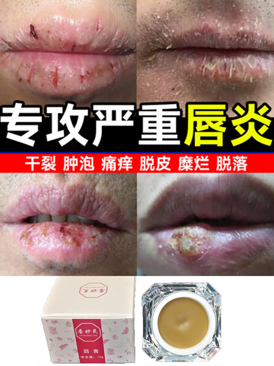 唇炎膏唇妙灵唇部起皮干裂滋润保湿修复唇膏儿童护唇炎药膏专用