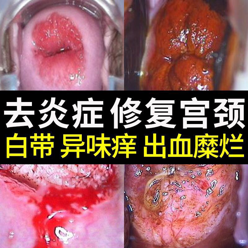 一折妇科炎症凝胶霉菌性