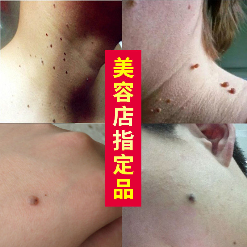 专去脖子上的小肉粒颈部腋下长肉粒猴子肉粒疙瘩除刺猴皮赘去除膏