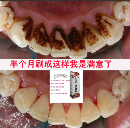 口益清烟渍净牙膏美白牙齿去烟渍牙结石去牙渍除渍增白网红牙膏