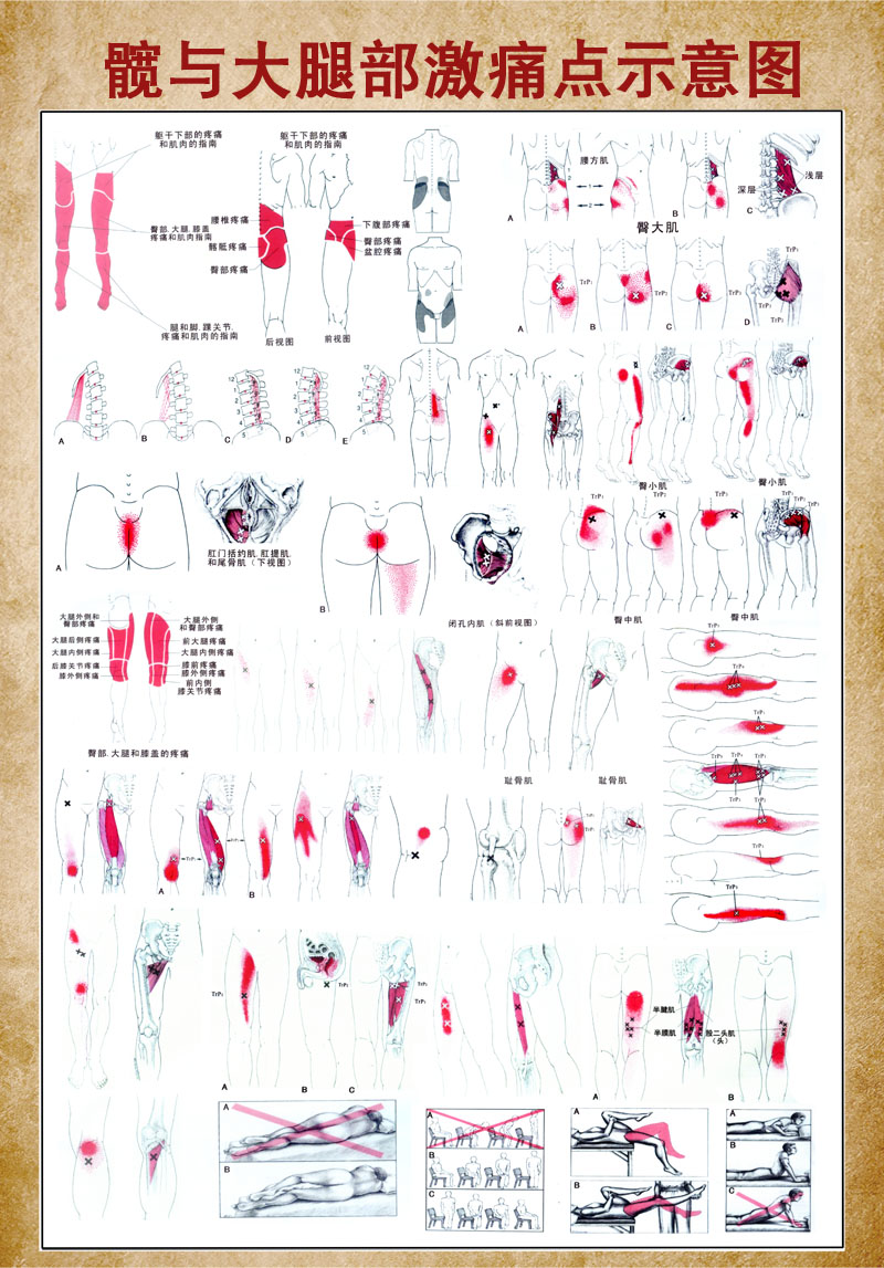 m768骨骼骨架大腿腿部激痛点示意图1449海报印制写真