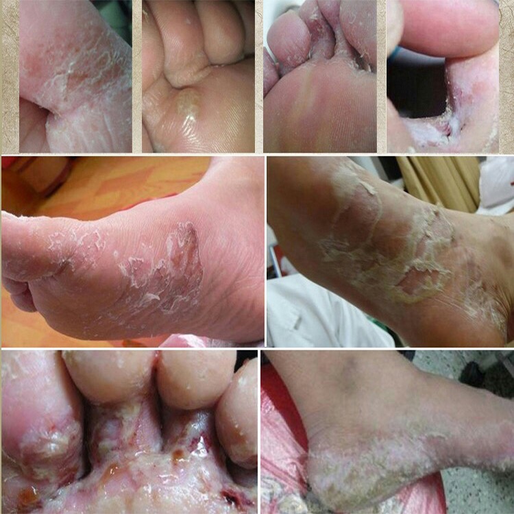 香港脚臭_脚气王喷剂止痒脱皮杀菌正品脚臭泡脚水香港水泡型烂脚丫