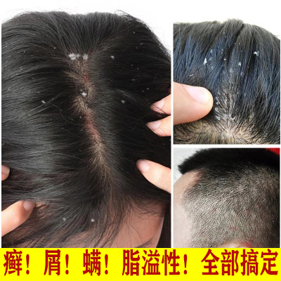 去头癣药膏头皮屑头部脂溢性皮炎藓洗发水中药治疗毛囊炎神器外用
