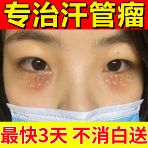 汗管瘤眼部去除去脂肪粒图片