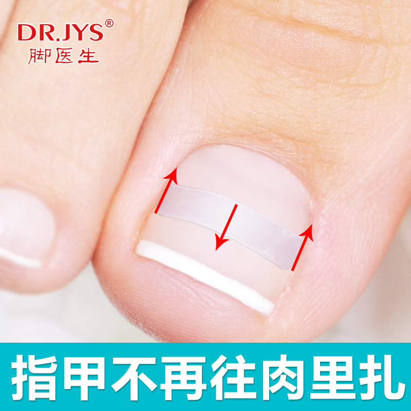 Foot doctor Paronychia Ingrown Toenails Lara nail Toenail Dedicated Correct Orthotic device Patchin the Family/Personal Cleaning Tools , Personal care cleaning appliances , Nail clippers/Nail clippers , Nail/Manicure Set category - from Buy2taobao.com to provide professional Taobao agent buy service