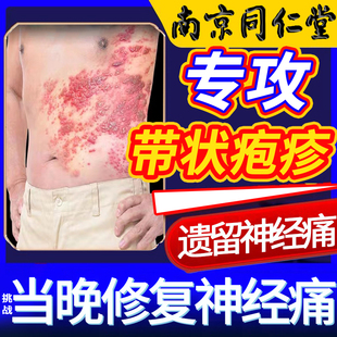 带状疱疹后遗症神经痛蛇盘疮蛇缠腰专用药外用膏快速痛治痛G