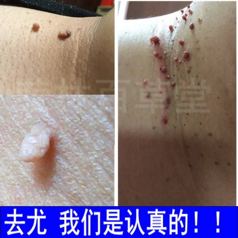 草本克疣液丝状疣脖子颈部去除肉粒疙瘩祛瘊子扁平尤克优膏疣瘊净