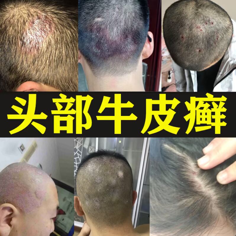 热销毛囊炎特效_头癣头皮癣头部特效药毛囊炎头癣药膏真菌感染洗头膏