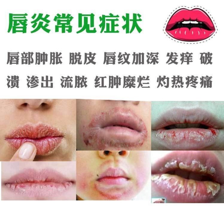 修复治口唇烂嘴角唇炎干裂口上火痒起泡疹脱皮性疱专用的用唇膏 - 美