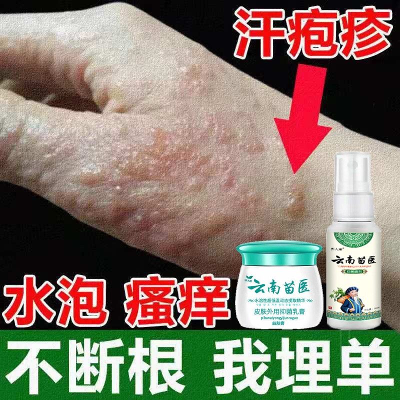 手癣手足癣手藓鹅掌风汗疱疹湿疹止痒去根干裂脱皮真菌感染药膏