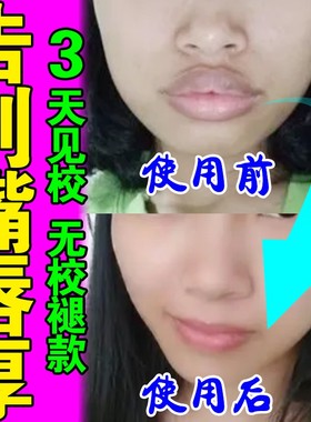 嘴唇变薄变小神器缩小嘴巴改善唇周米白黑嘴唇外翻矫正瘦嘴唇专用