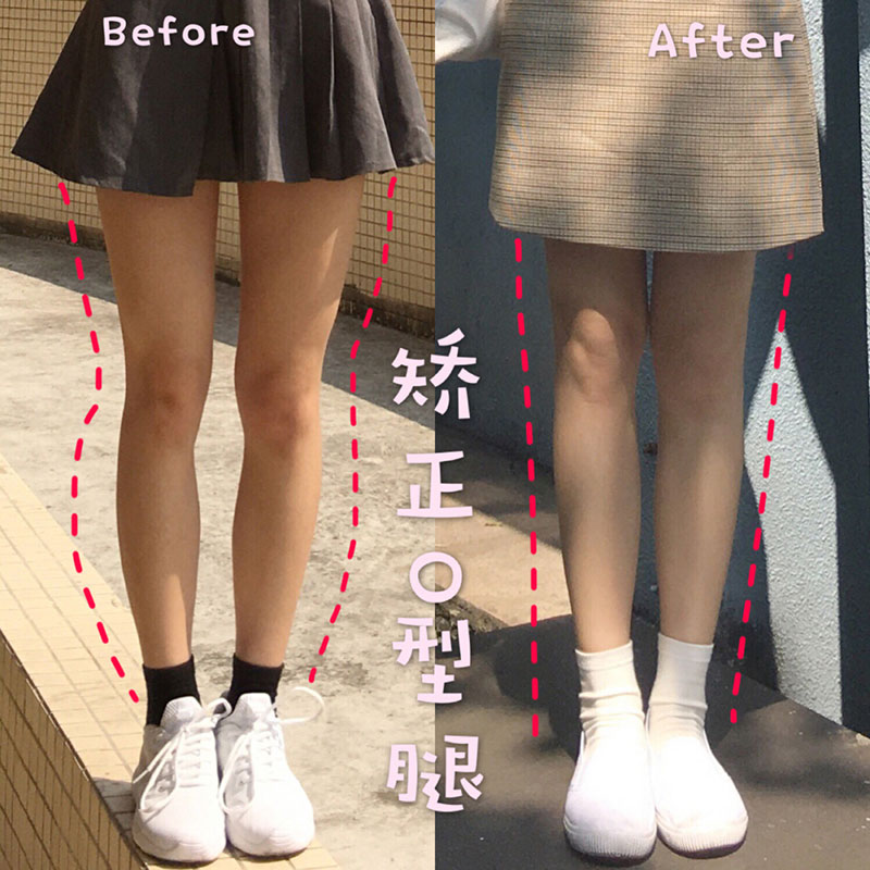 推荐o型腿鞋垫罗圈腿器适用于xo腿
