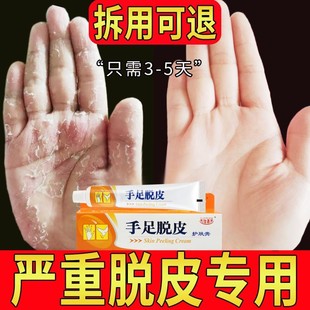 手足手脱皮的药膏儿童手指真菌感染专治手脚干裂蜕皮严重起皮专用