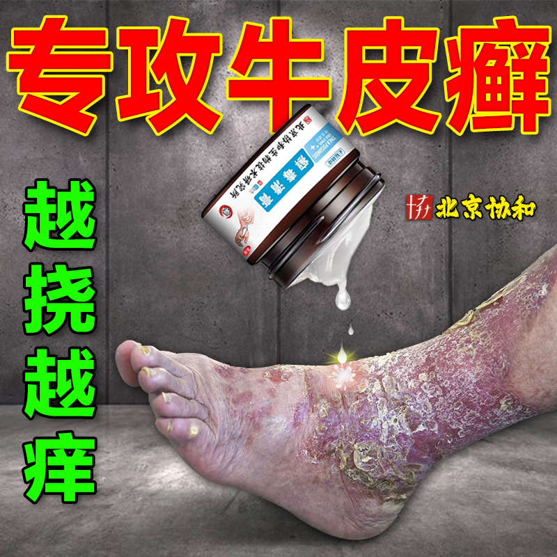 北京协和牛皮癬药膏癣银屑病真菌感染去手癣膏脱皮干裂藓专止用根