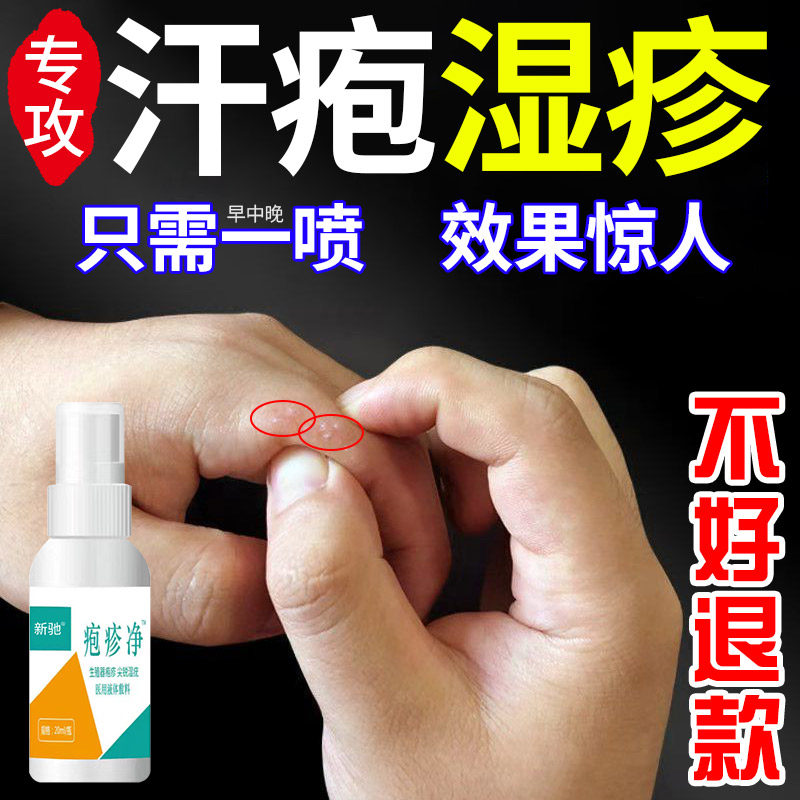 汗疱湿疹用品手上手指背脚部屁股皮肤小水泡汗疱疱疹专用止痒药膏