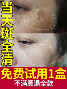 祛斑霜祛黄褐斑老年斑雀斑一抹净强力去除淡化手背脸上的专用药膏