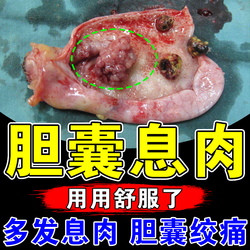 胆囊息肉中i药贴胆囊多发息肉胆囊i