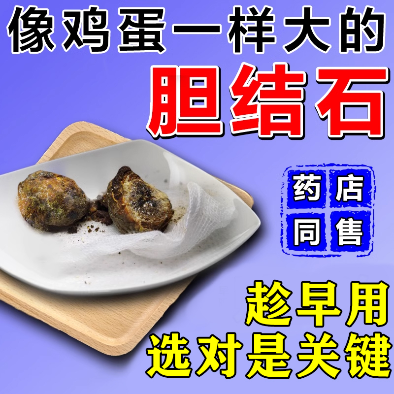 胆结石溶石化石排石膏贴胆囊息肉急慢