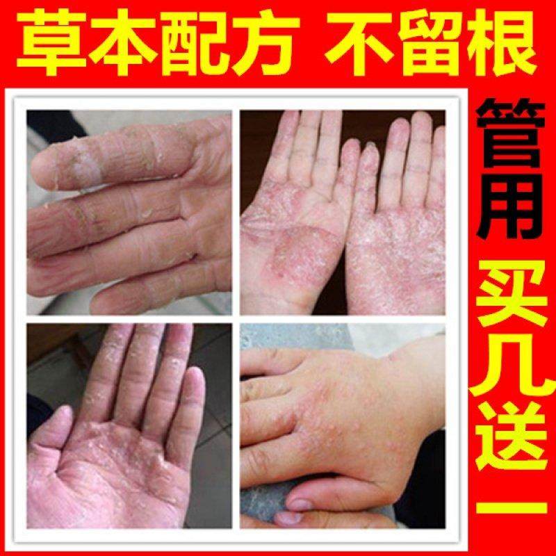 手痒起小水泡脱皮干裂手指起皮干燥医药荣氏止痒膏