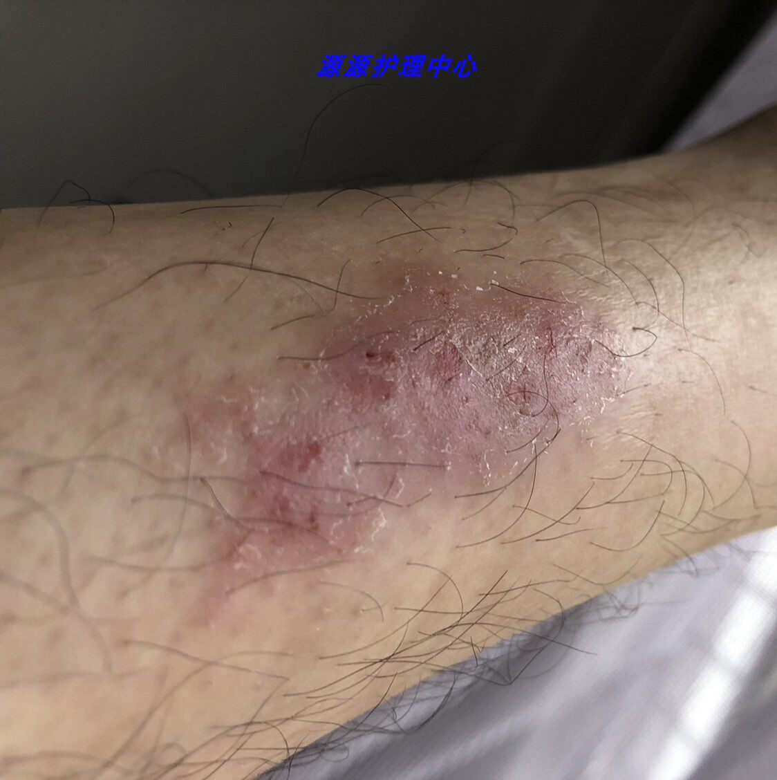 皮毒癣痒神药膏牛皮癣银屑病皮肤瘙痒止痒湿疹头皮癣特效中草药水