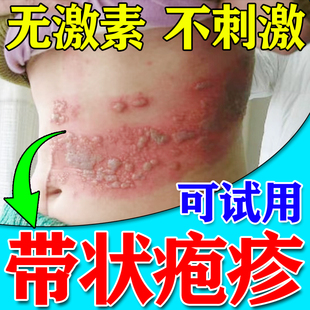 蛇盘疮带状疱疹后遗症神经痛外用膏蛇缠腰胆疮快速止痛止痒药膏Z