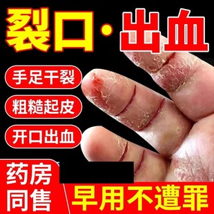 治手裂的药膏手指裂口手开裂脱皮防皲裂脚后跟手脚干裂专用防裂膏