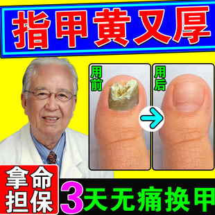 脚指甲发黄变厚灰甲神器脚趾甲变厚指甲盖发黄变硬黄坏甲空甲修复