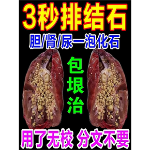 治疗胆结石溶石化石排石特效专用药金钱草花石草胆囊息肉中药