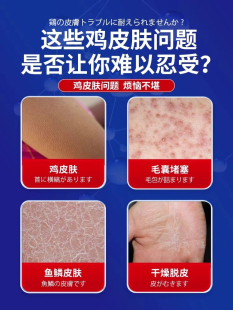 去鸡皮肤疙瘩毛囊角化去角质身体乳磨砂膏身体嫩白全身祛印尿素霜