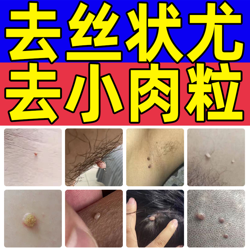 丝状疣脖子上长小肉粒疙瘩猴子皮赘腋窝面颈部腋下非祛去除膏神器