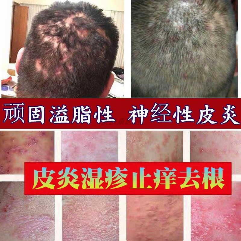 神经性脂溢皮炎面部进口无激素外用药膏专用治疗湿疹皮肤顽固瘙痒