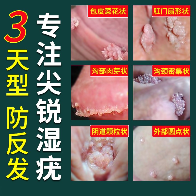 尖锐湿疣男湿庞检测自检疣克星女性私处药膏去除非治疗鬼臼毒素酊在类目 OTC药品/医疗器械/计生用品, 医疗器械, 私处护理(器械)中 - 来自Buy2taobao.com提供专业的淘宝代购服务
