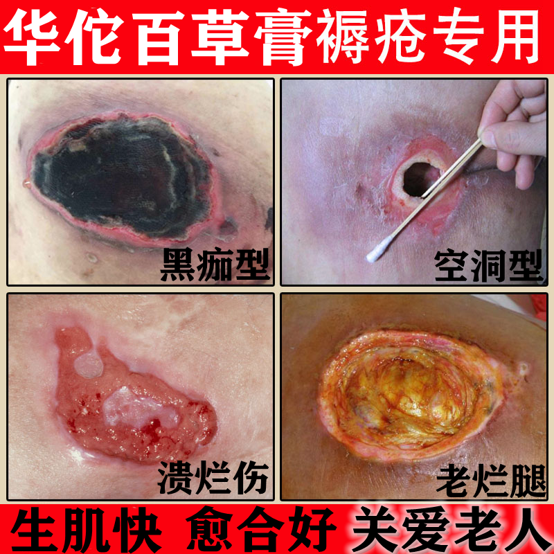 老人褥疮膏老烂腿伤口愈合结痂压疮去腐生肌修复臀部重度疮外用药