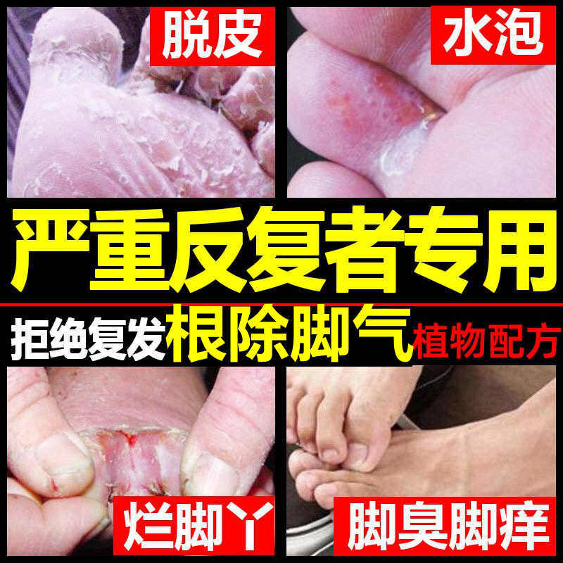 治脚气去根神器止痒脱皮杀菌水泡型喷剂除脚臭治疗真菌感染药膏王