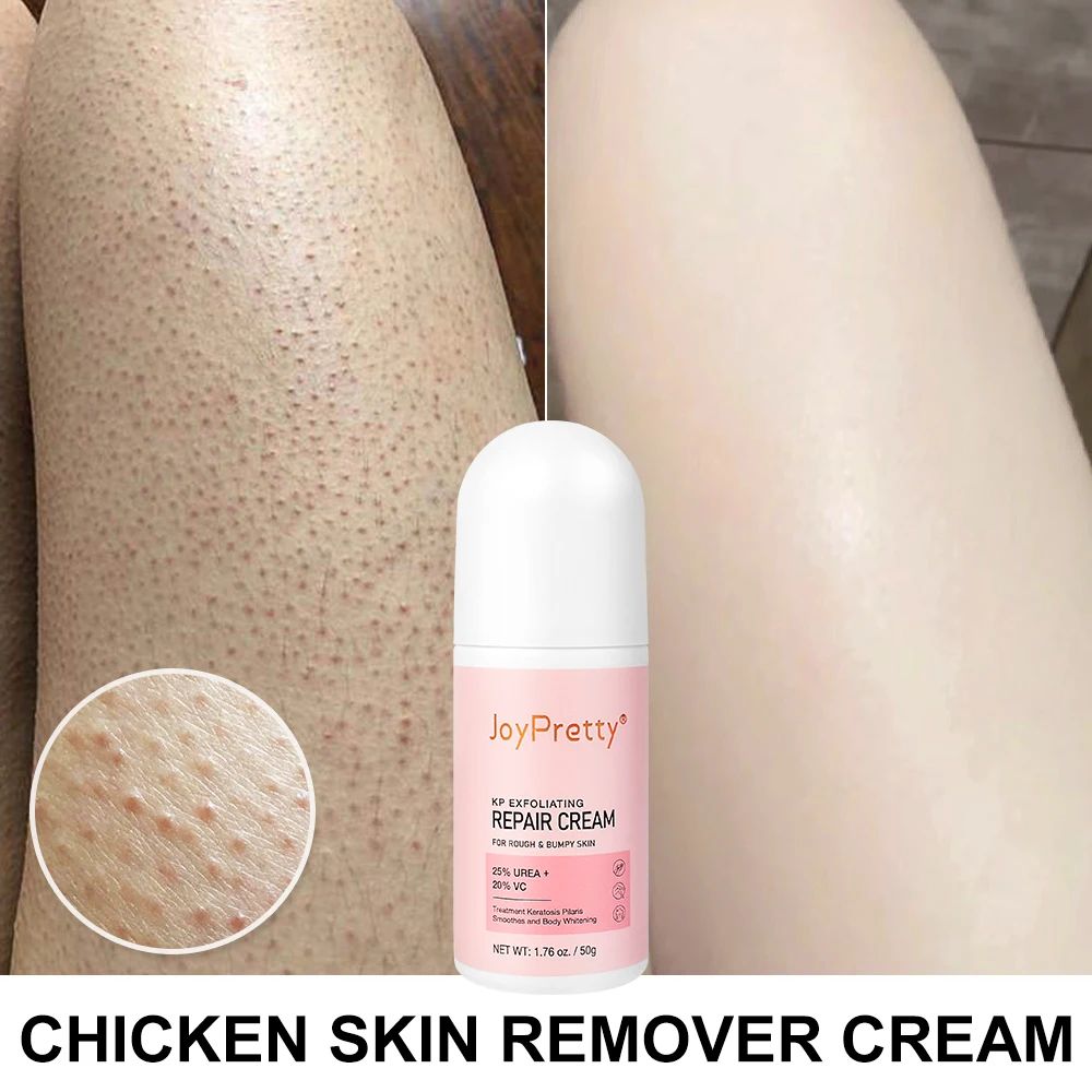 Body Cream Chicken Skin Removal Treatment Keratosis Pilaris