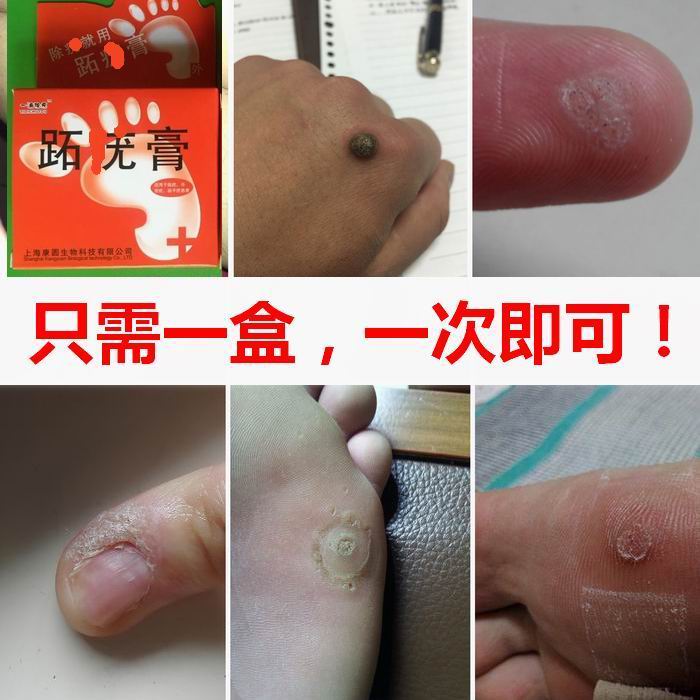 鸡眼膏贴跖尤贴刺猴鱼休子鱼鳞痣手足肉刺老茧血泡疱刺鸦胆子在类目 洗护清洁剂/卫生巾/纸/香薰, 洗发沐浴/个人清洁, 身体护理, 身体磨砂膏/去角质膏中 - 来自Buy2taobao.com提供专业的淘宝代购服务