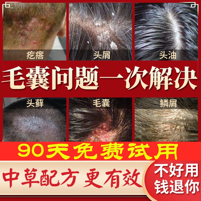 治毛囊的炎洗发水治疗头皮专用药去头屑癣止头痒控油去螨虫除螨露