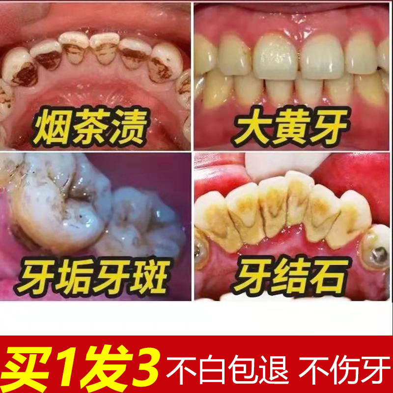 洁牙慕斯泡沫牙膏美白牙齿去黄去口臭牙垢亮白牙结石口气清新正品