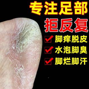 极速杀菌儿童喷剂外用苗家脚气去真菌泡脚药包专用抑菌脱皮中药膏