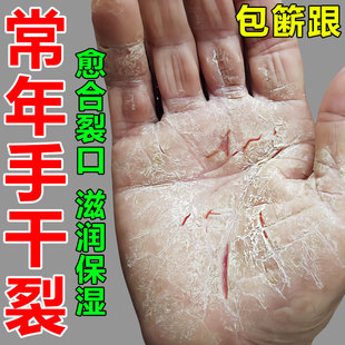 速发【100%修复】治手裂的药膏防干裂手指开裂脚后跟裂口干燥粗糙