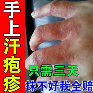 极速汗疱疹手痒脱皮汗孢疹汗状孢疹专用治疗手足癣手脚上起小水泡