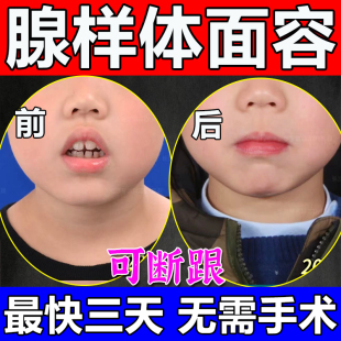 推荐儿童腺样体肥大调理中药贴张嘴呼吸鼻塞打呼嘴唇上翘面容矫正