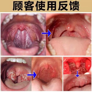 速发扁桃体肥大肿大贴治疗儿童嗓子干痒发炎药咽喉肿痛喉咙有痰异