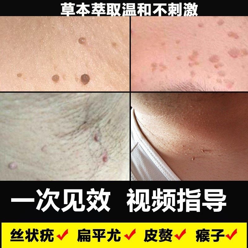 草本克疣液丝状疣脖子颈部去除肉粒疙瘩祛瘊子扁平尤克优膏疣瘊净
