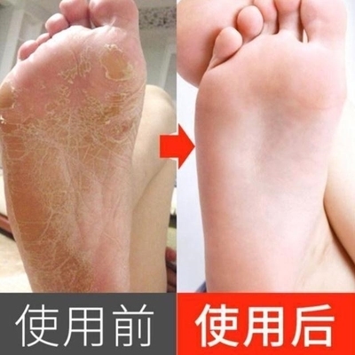 脚后跟裂皮是怎么回事(脚后跟干裂脱皮是什么原因)