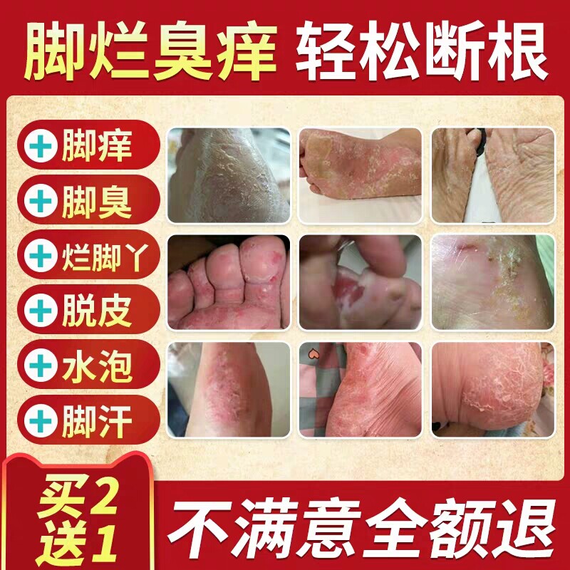 一折脚气脚臭水泡_治疗香港脚气喷剂止痒脱皮去烂脚丫水泡型真菌感染